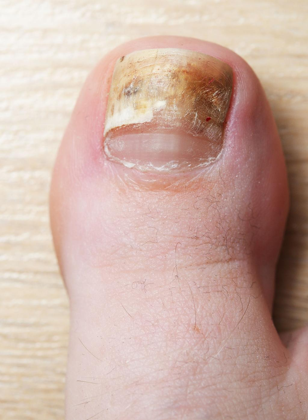 Nail Fungus